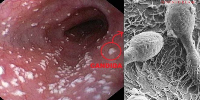 Candida And Salt Can Urine Cause Leakage