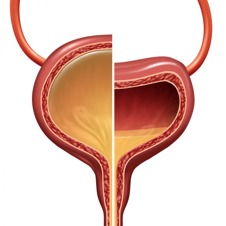 Could I Have an Overactive Bladder?