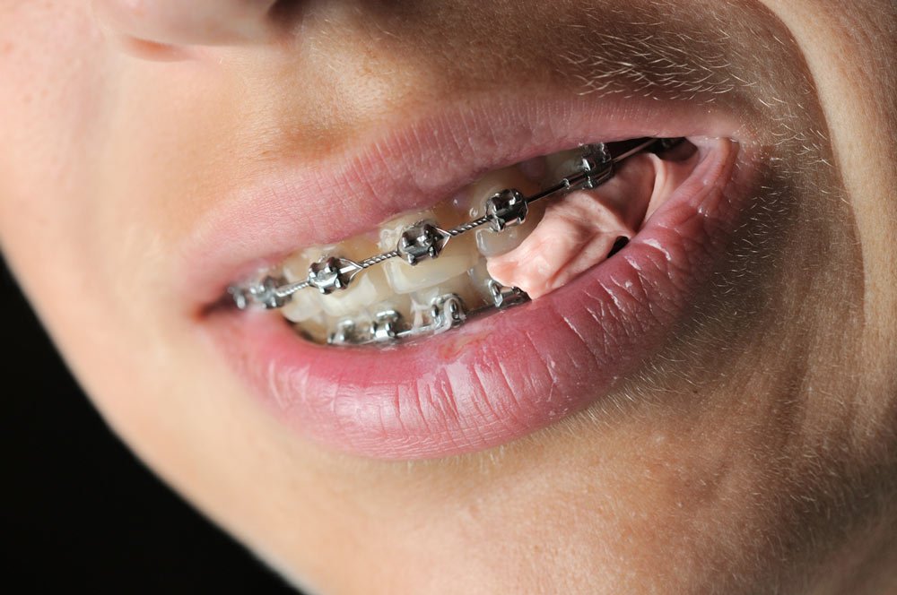 Gum for Braces: The Surprising Benefitsof Chewing Gum with ...