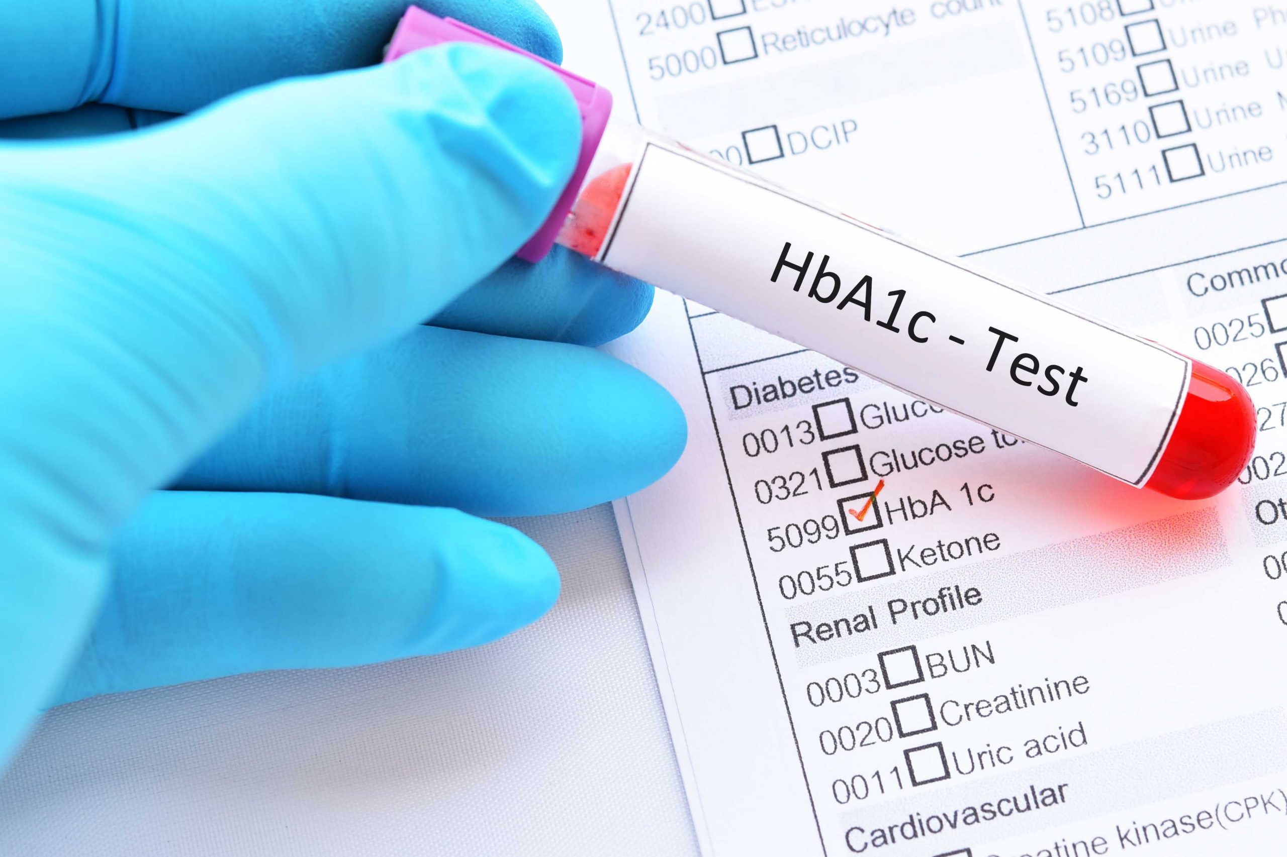 HbA1c Test for Diabetes