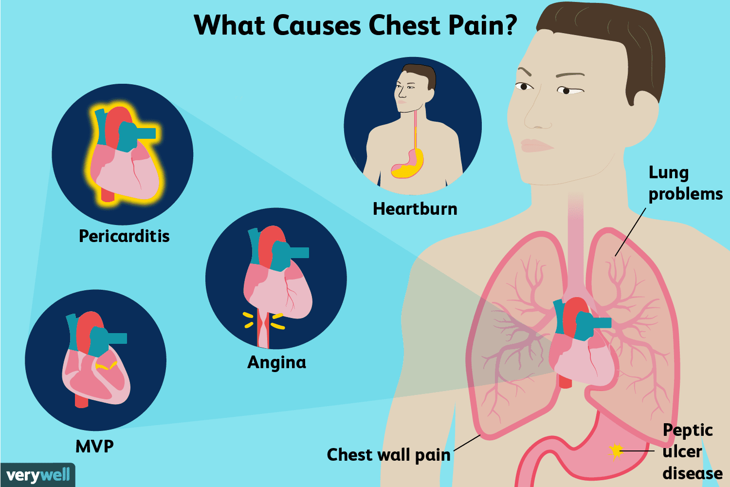 How Do You Tell If Chest Pain Is a Serious Emergency?