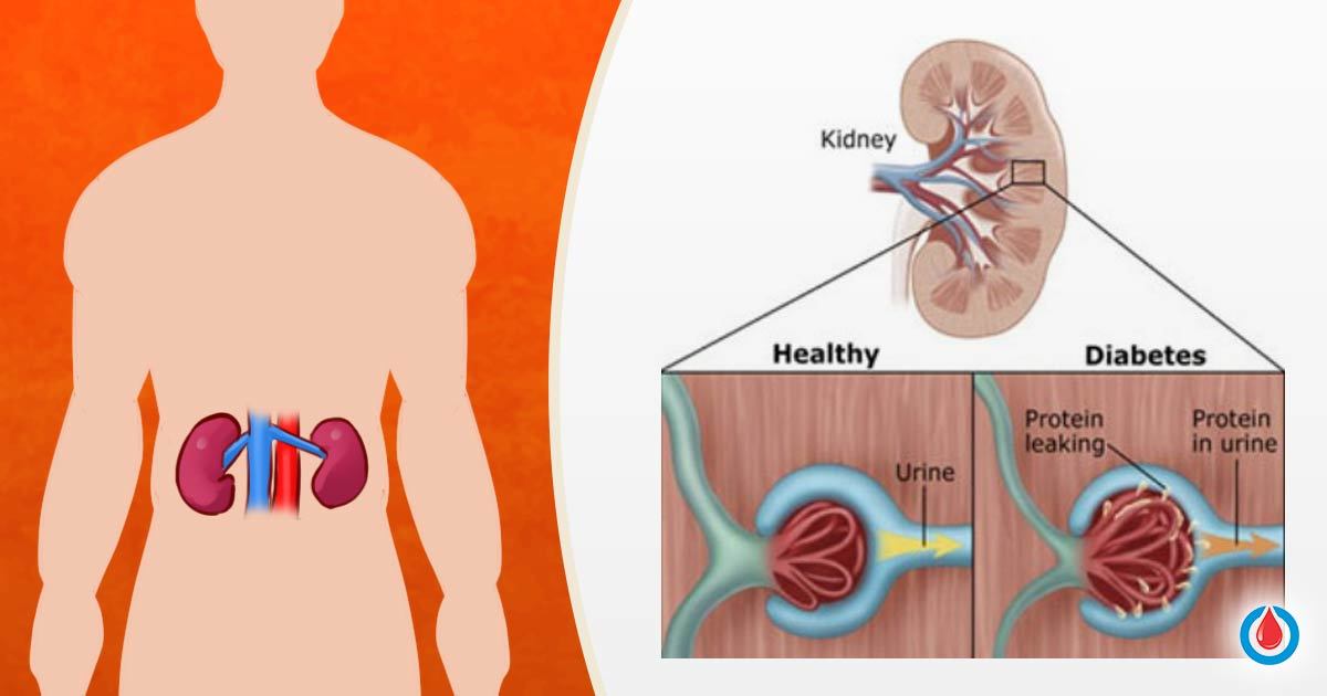 Does High Blood Sugar Affect Kidneys - SugarProTalk.com