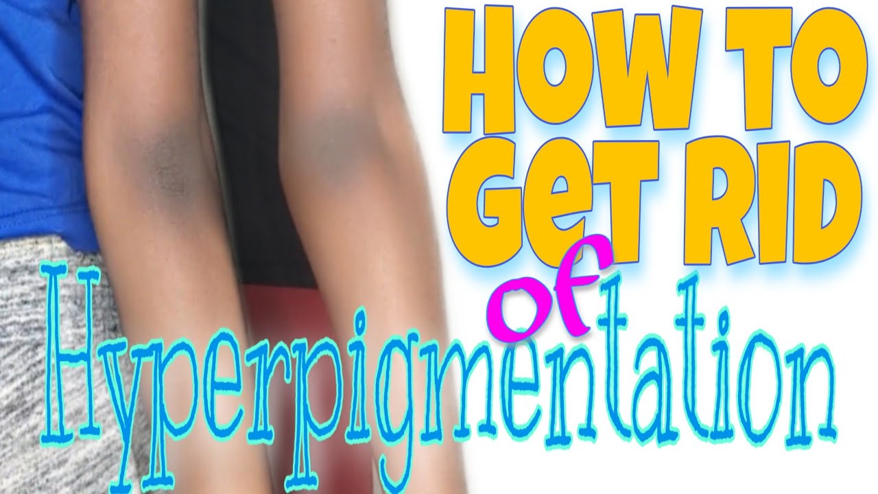 How To Get Rid Of Hyperpigmentation