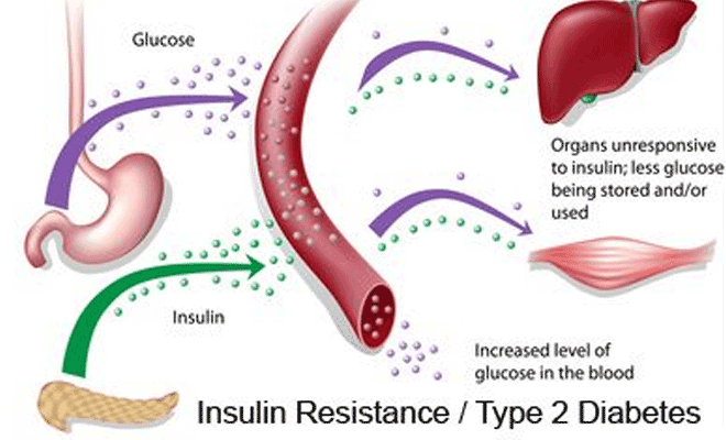 Insulin Resistance: Causes, Symptoms, Diagnosis ...