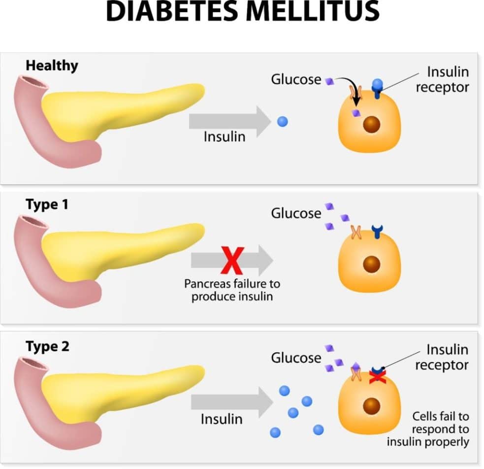 Insulin Sensitive Prediabetic Diabetic  Why Constant Sugar Consumption ...