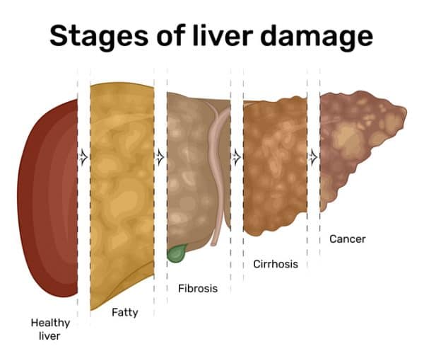 This ONE Nutrient Can Protect You from Fatty Liver Disease ...