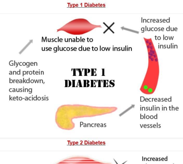 Type 1 Diabetes Glucose Levels